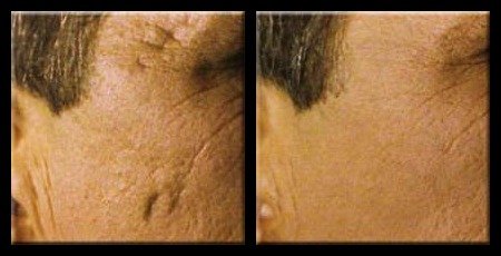 microneedling with radiofrequency