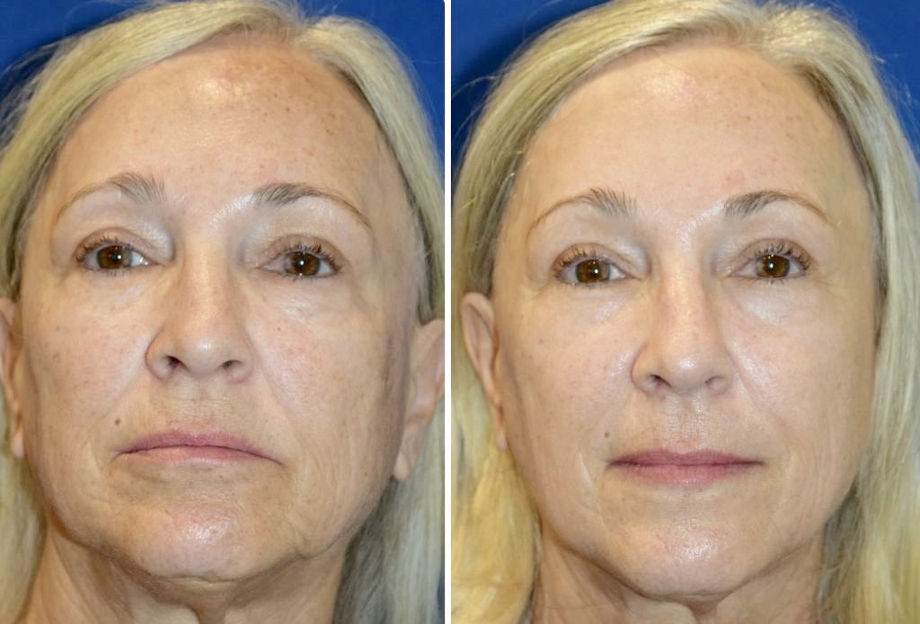 microneedling-with-radiofrequency. 