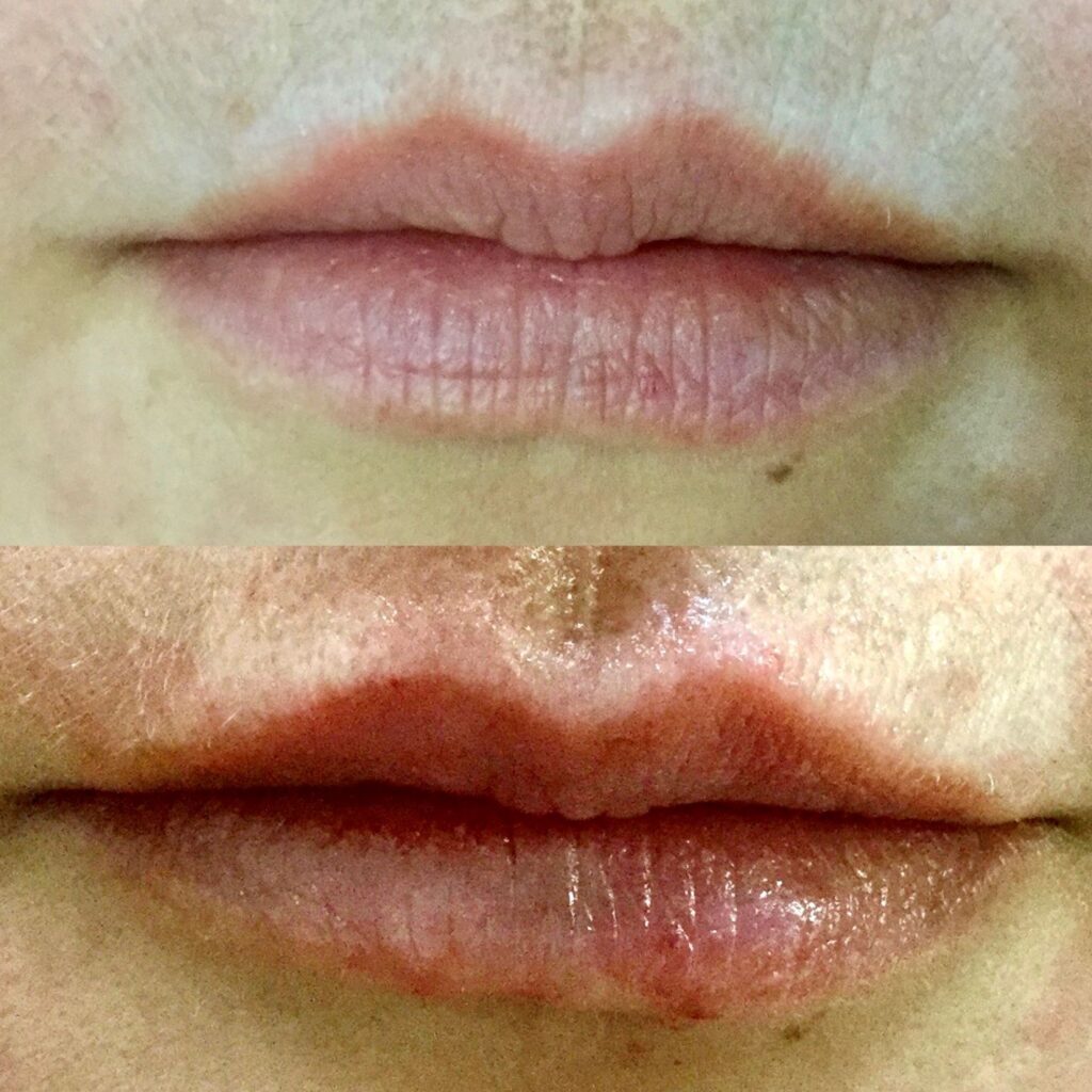 russian-lips-skin-laser-lipo-cincinnati-botox