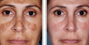 Cincinnati-Dermatology-Skin-Laser-1