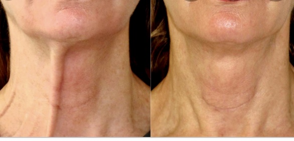 Botox-Cincinnati-before-and-after