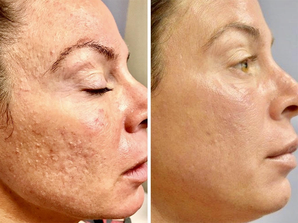Pearl-Fractional-Skin-Laser-Cincinnati-Dermatologist