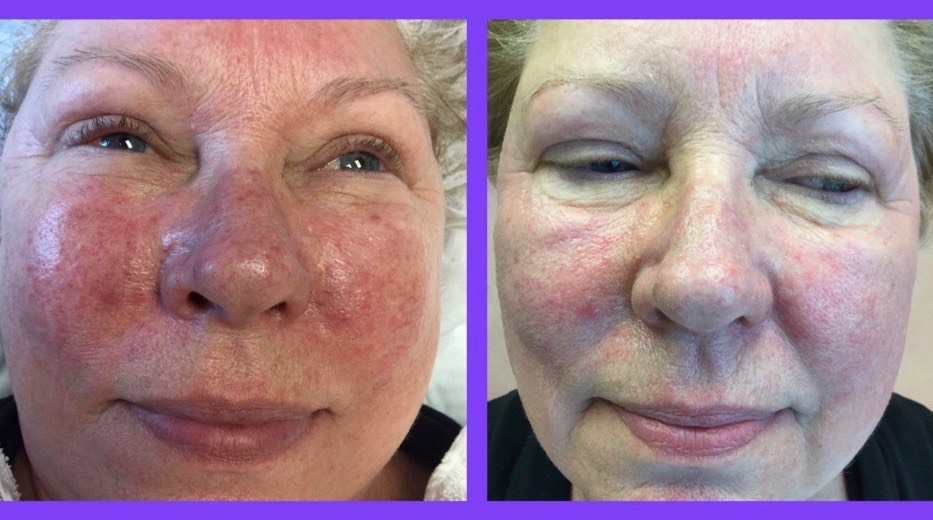 anti-aging-clinic-Cincinnati-Dermatology-Dr-Porras-skin-laser-technology 