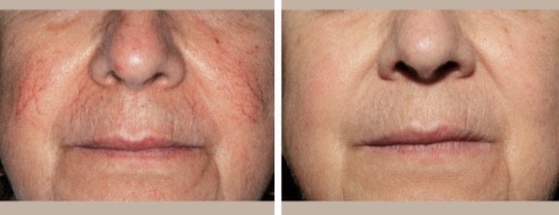 Cincinnati-Dermatology-for-laser-vein-removal
