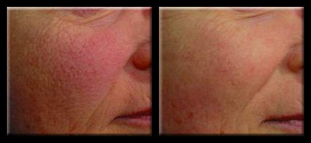 Cincinnati-Dermatology-Dr-Porras-skin-laser-technology 