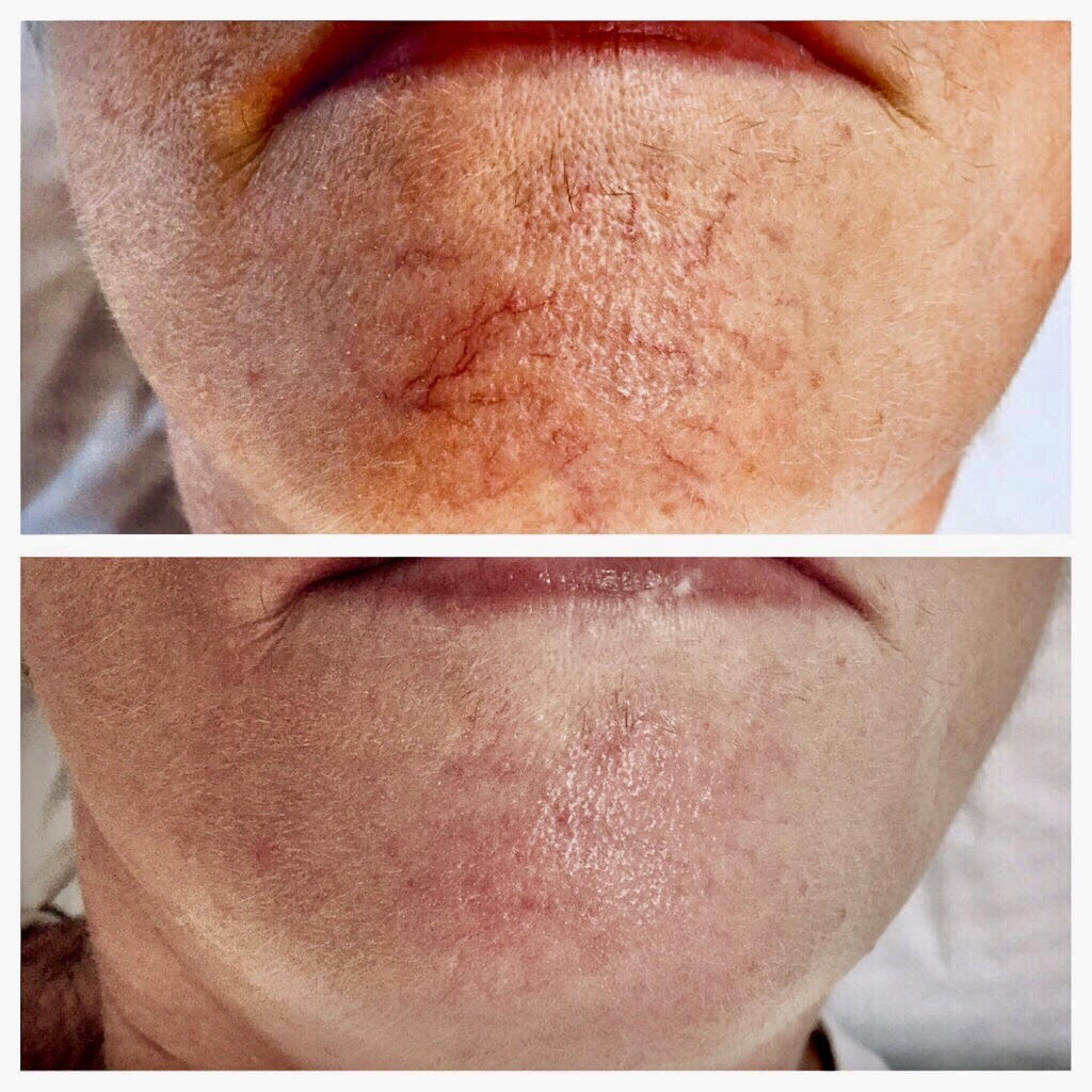 skin-laser-Cincinnati-Dermatology-for-laser-vein-removal