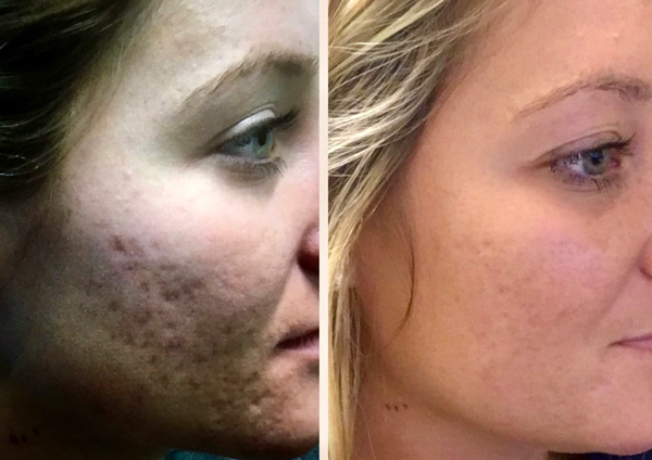 microneedling-with-radiofrequency