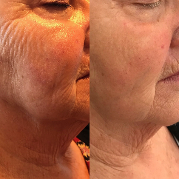 microneedling-with-radiofrequency-2