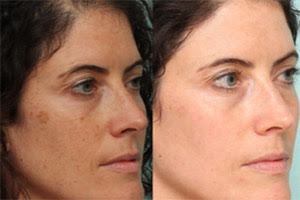 Cincinnati-Dermatology-Skin-Laser-2