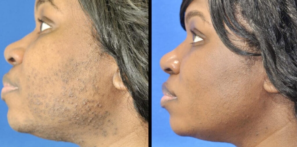 Laser-Hair-Removal-Cincinnati-skin-laser