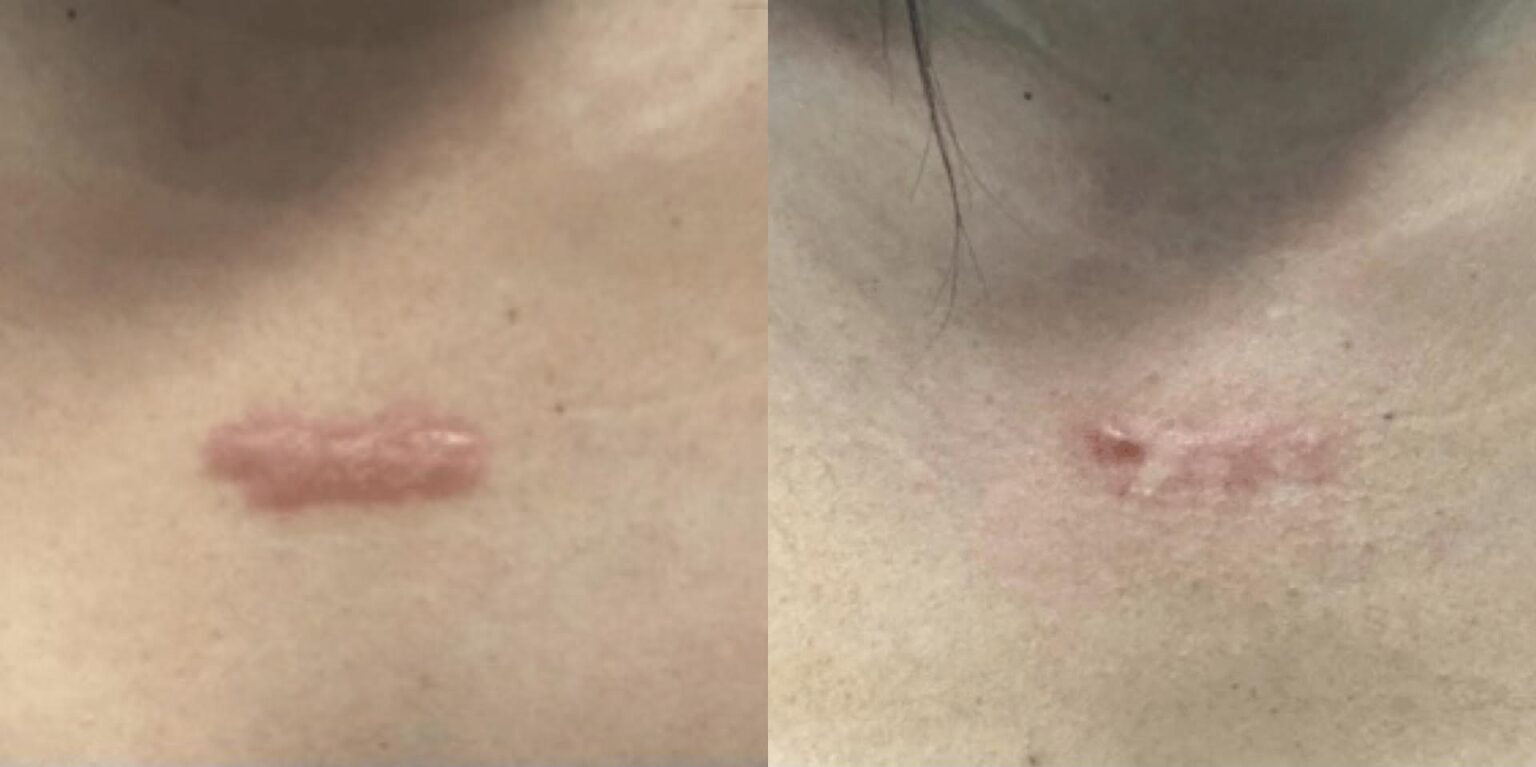 Keloid Scar Treatment Glasgow at Karen Clinkscales blog